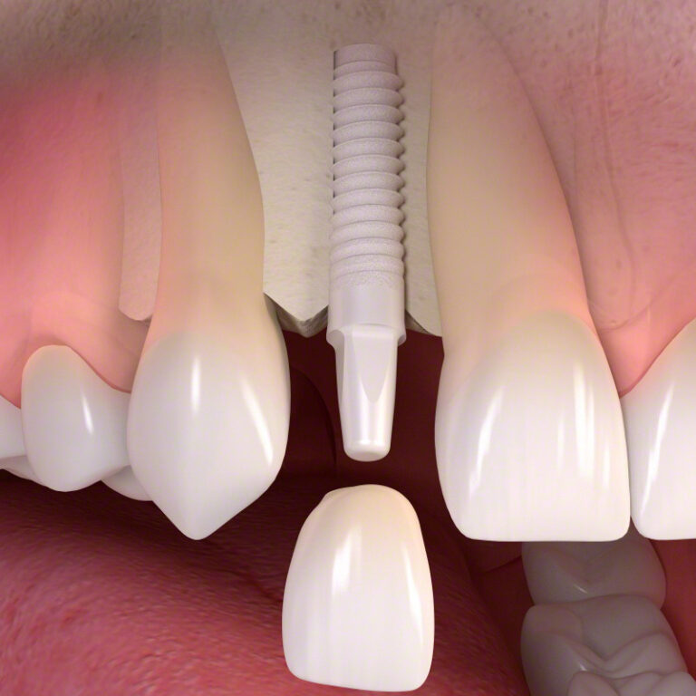Ceramic_implant-borne_single-tooth_treatment_03