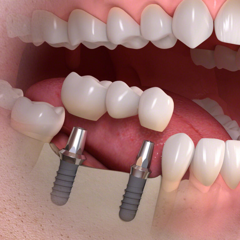 Implant-borne_multi-tooth_treatment_03